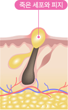 죽은세포와 피지