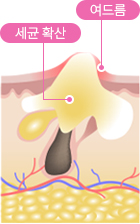 세균확산, 여드름